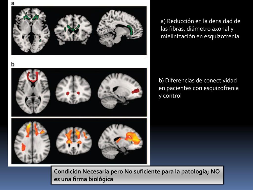 a) Reducción en la densidad de las fibras, diámetro axonal y mielinización en esquizofrenia