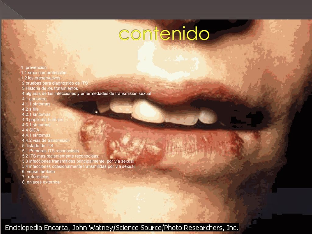 contenido 1. prevención 1.1 sexo con protección 1.2 los preservativos