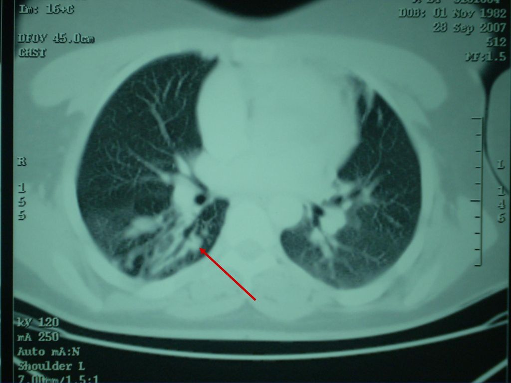 En esta imagen del TAC de tórax se observa un pequeño infiltrado intersticio-alveolar en segmento 6 de LID.