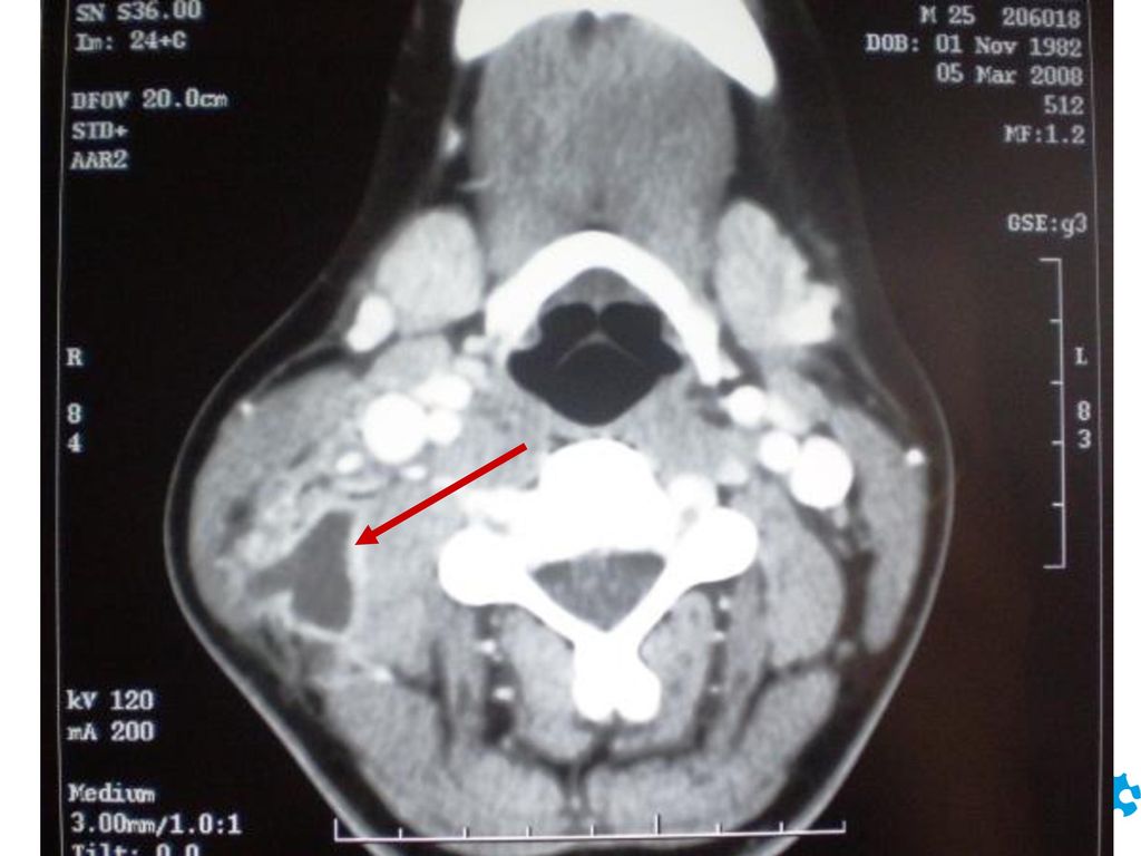 La flecha indica la adenopatía con centro de necrosis y realce periférico tras la administración de contraste.