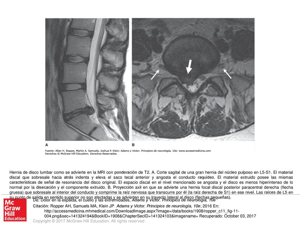 Hernia de disco lumbar como se advierte en la MRI con ponderación de T2. A. Corte sagital de una gran hernia del núcleo pulposo en L5-S1. El material discal que sobresale hacia atrás indenta y eleva el saco tecal anterior y angosta el conducto raquídeo. El material extruido posee las mismas características de señal de resonancia del disco original. El espacio discal en el nivel mencionado se angosta y el disco es menos hiperintenso de lo normal por la disecación y el componente extruido. B. Proyección axil en que se advierte una hernia focal discal posterior paracentral derecha (flecha gruesa) que sobresale al interior del conducto y comprime la raíz nerviosa que transcurre por él (la raíz derecha de S1) en ese nivel. Las raíces de L5 en su punto de salida en sentido superior no son afectadas y se advierten en su trayecto lateral al disco (flechas pequeñas).