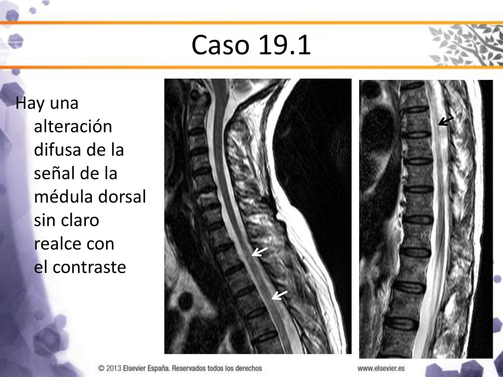 Caso 19.1 Hay una alteración difusa de la señal de la médula dorsal sin claro realce con el contraste.