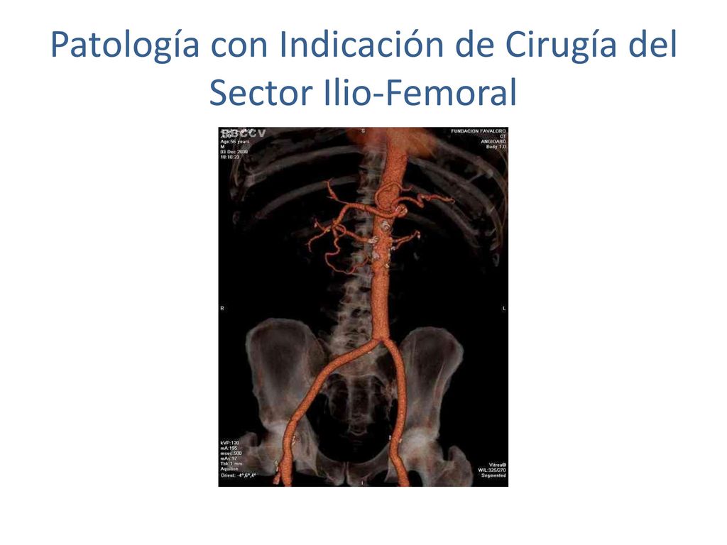 Patología con Indicación de Cirugía del Sector Ilio-Femoral