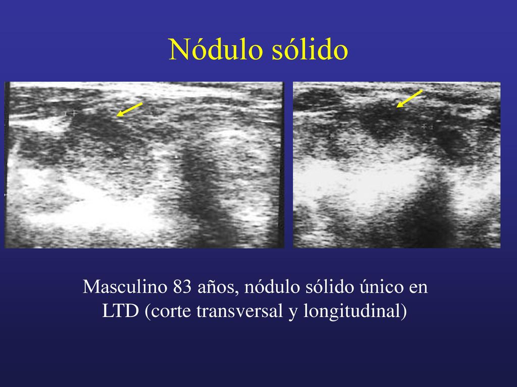 Nódulo sólido Masculino 83 años, nódulo sólido único en LTD (corte transversal y longitudinal)