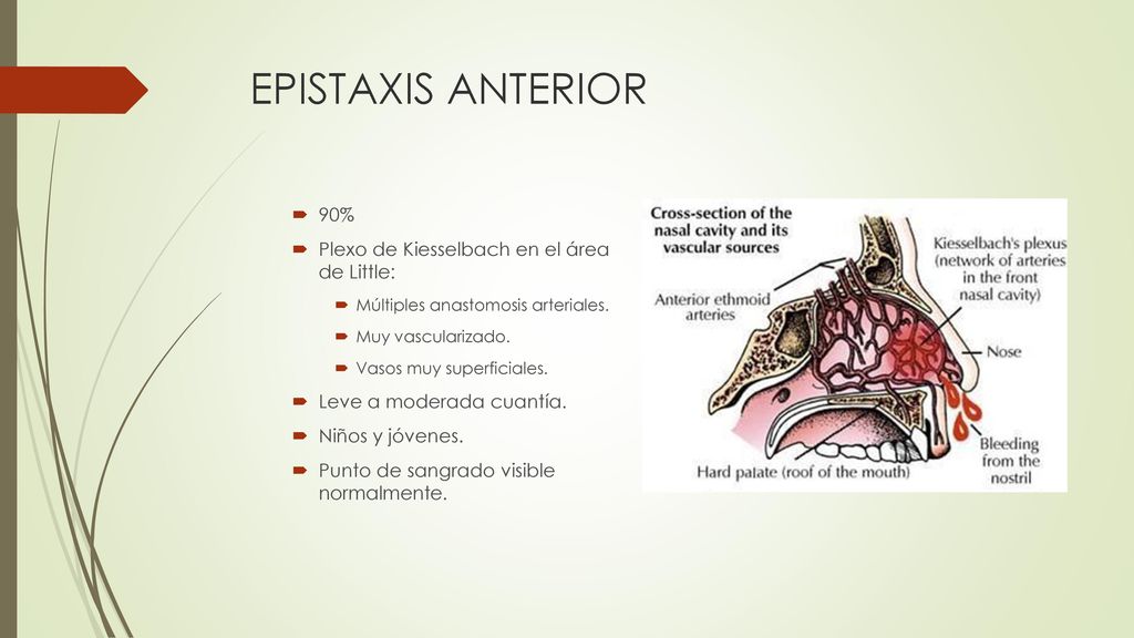 EPISTAXIS ANTERIOR 90% Plexo de Kiesselbach en el área de Little: