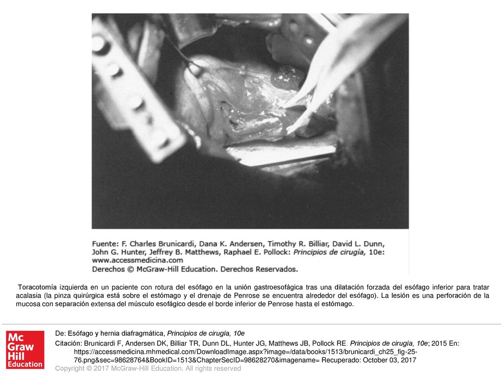 Toracotomía izquierda en un paciente con rotura del esófago en la unión gastroesofágica tras una dilatación forzada del esófago inferior para tratar acalasia (la pinza quirúrgica está sobre el estómago y el drenaje de Penrose se encuentra alrededor del esófago). La lesión es una perforación de la mucosa con separación extensa del músculo esofágico desde el borde inferior de Penrose hasta el estómago.