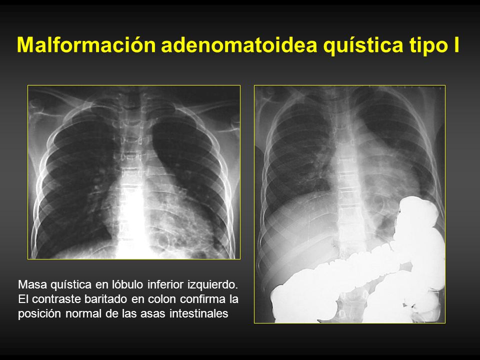 Malformación adenomatoidea quística tipo I