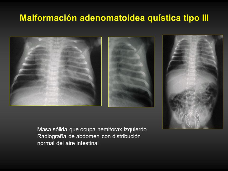 Malformación adenomatoidea quística tipo III