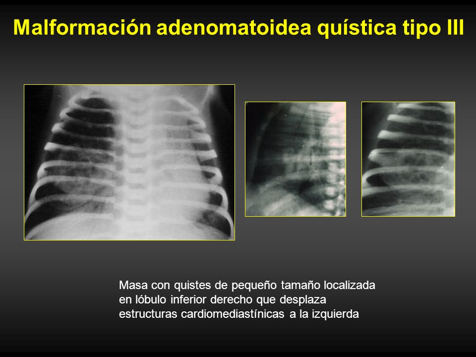 Malformación adenomatoidea quística tipo III