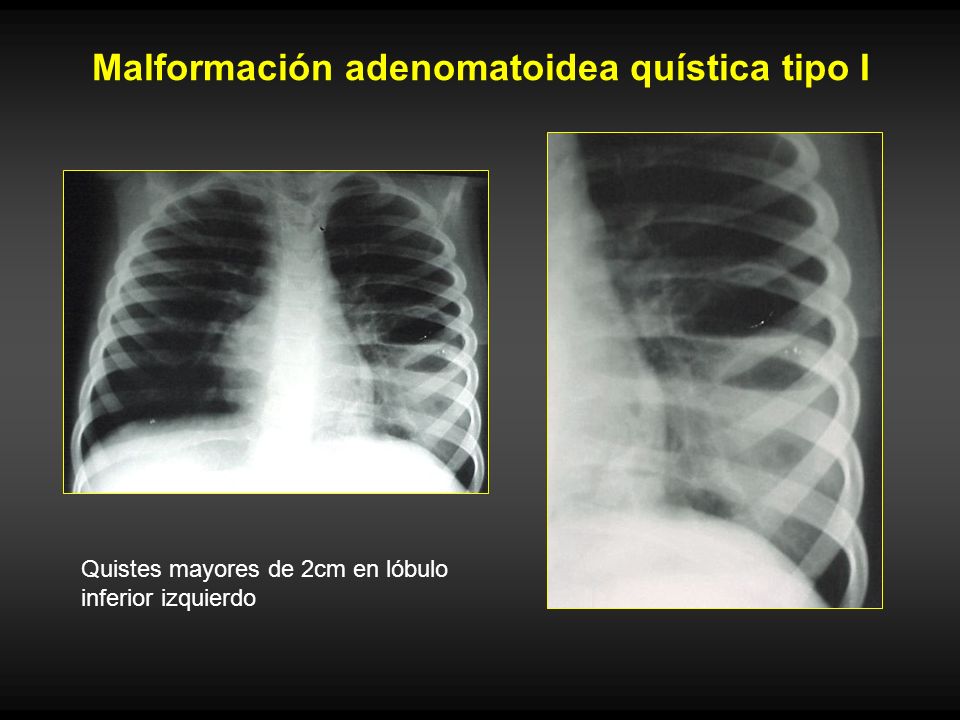 Malformación adenomatoidea quística tipo I