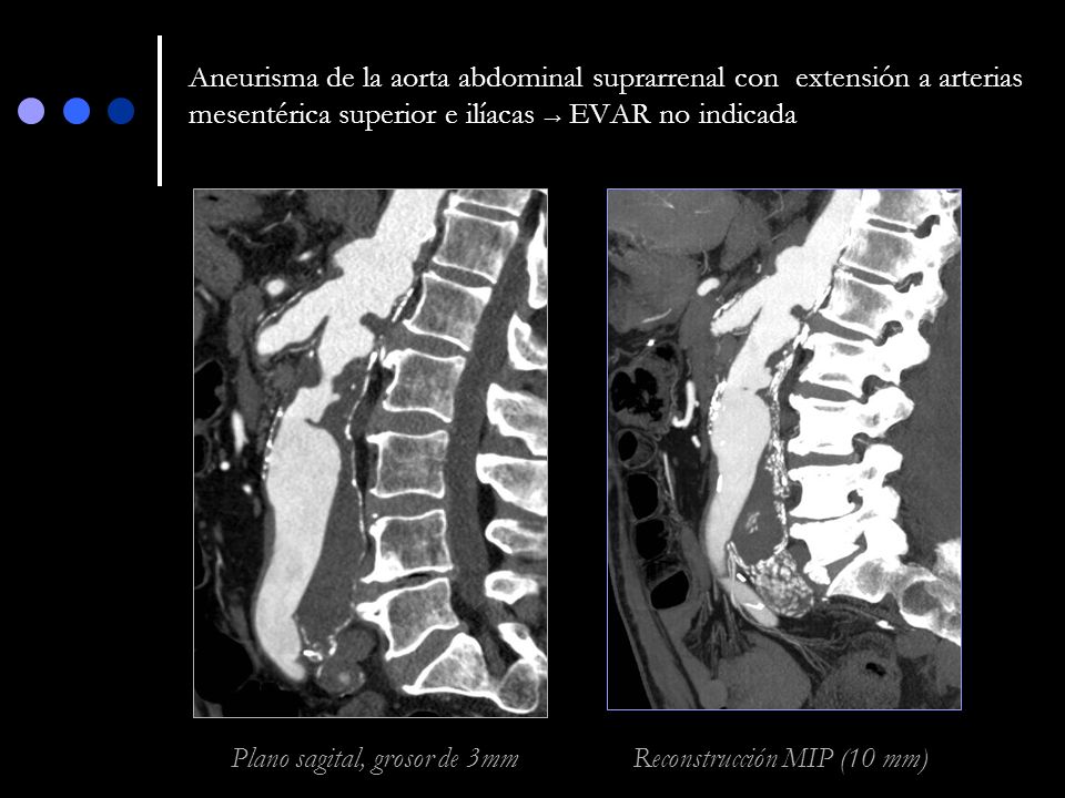 Aneurisma de la aorta abdominal suprarrenal con extensión a arterias mesentérica superior e ilíacas → EVAR no indicada
