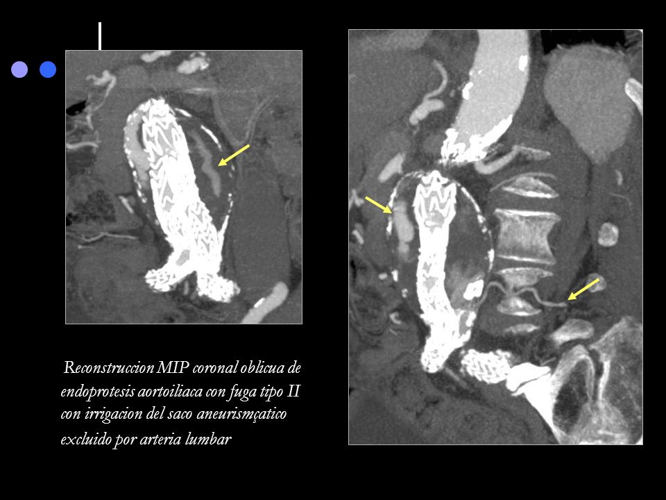 Reconstruccion MIP coronal oblicua de endoprotesis aortoiliaca con fuga tipo II con irrigacion del saco aneurismçatico excluido por arteria lumbar