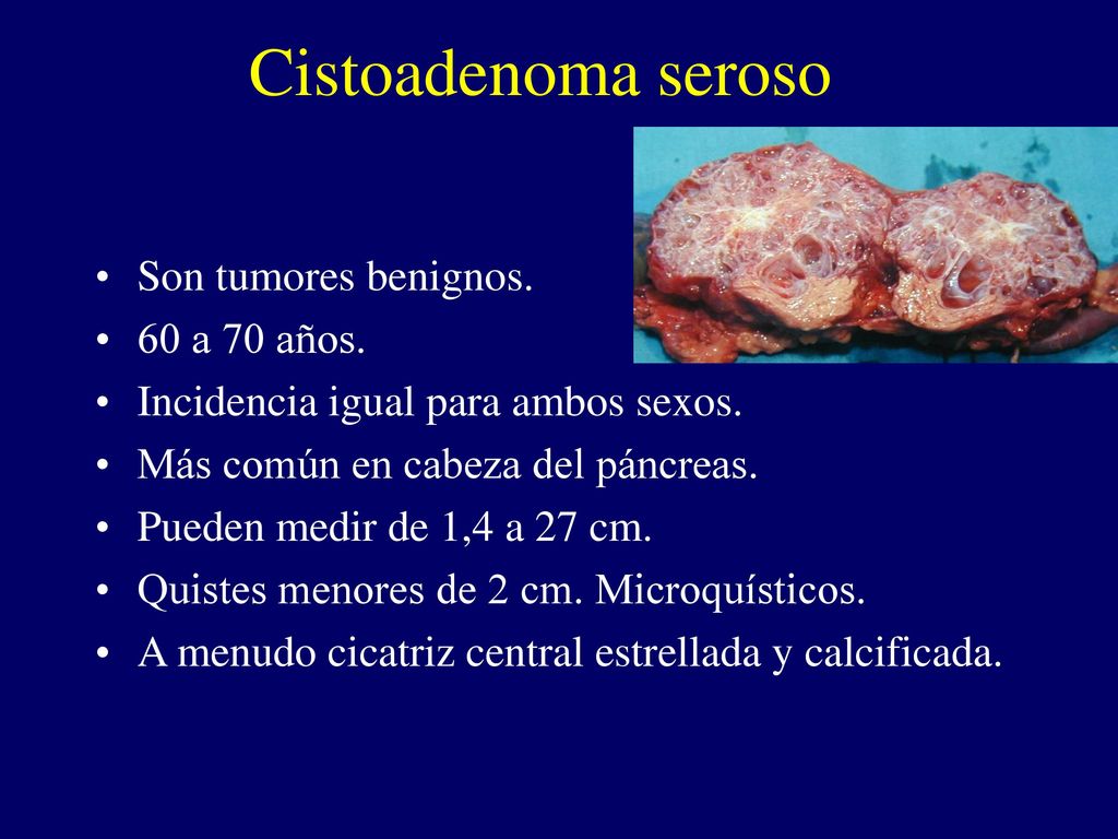 Cistoadenoma seroso Son tumores benignos. 60 a 70 años.