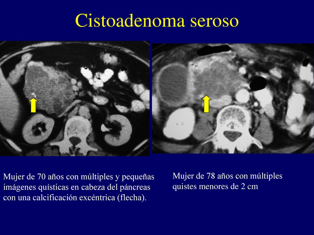 Cistoadenoma seroso Mujer de 70 años con múltiples y pequeñas imágenes quísticas en cabeza del páncreas con una calcificación excéntrica (flecha).