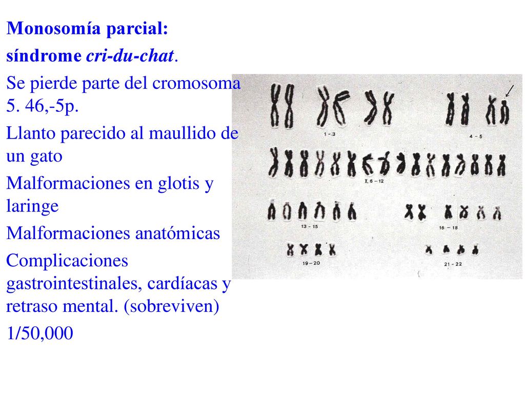 Monosomía parcial: síndrome cri-du-chat. Se pierde parte del cromosoma 5. 46,-5p. Llanto parecido al maullido de un gato.