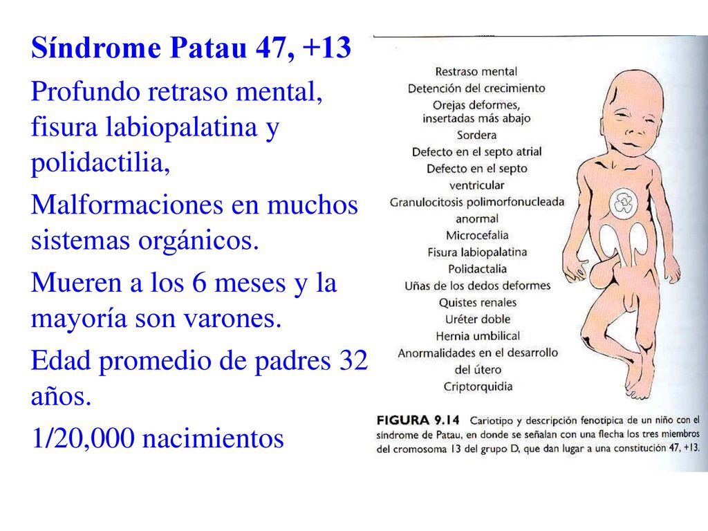 Síndrome Patau 47, +13 Profundo retraso mental, fisura labiopalatina y polidactilia, Malformaciones en muchos sistemas orgánicos.