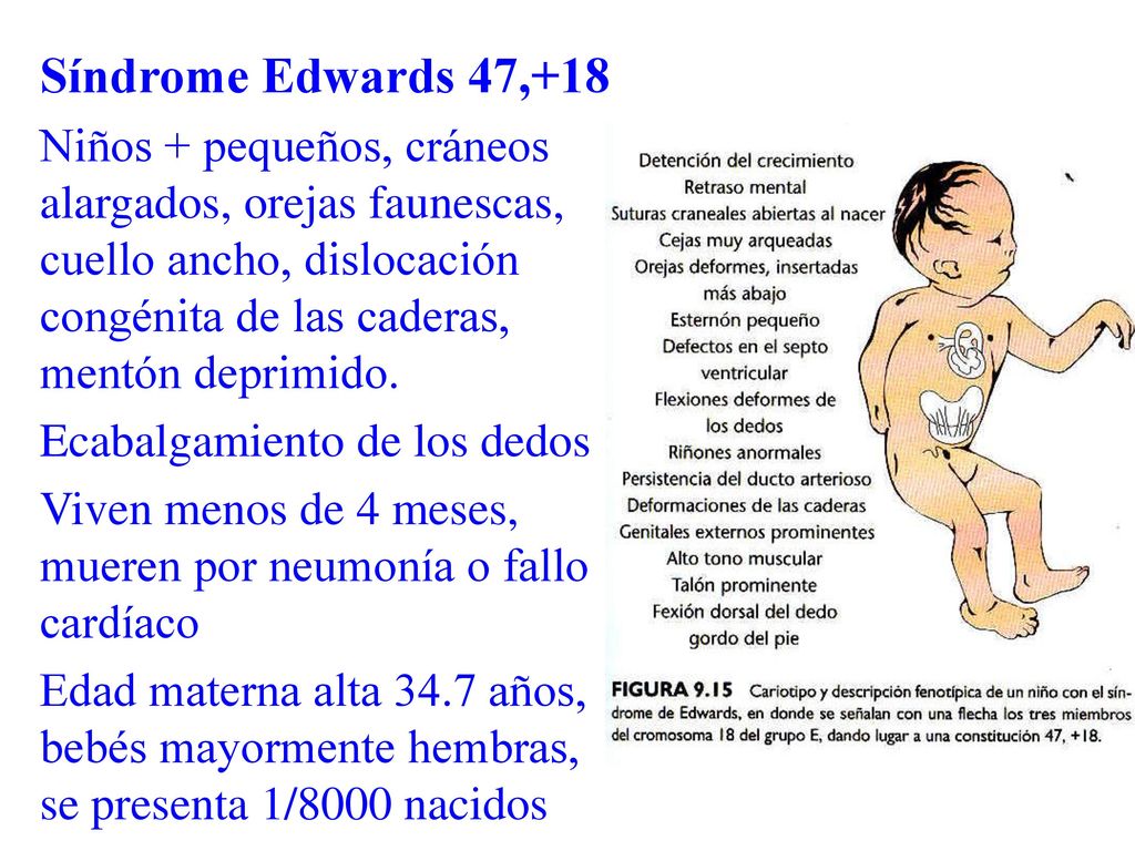 Síndrome Edwards 47,+18 Niños + pequeños, cráneos alargados, orejas faunescas, cuello ancho, dislocación congénita de las caderas, mentón deprimido.