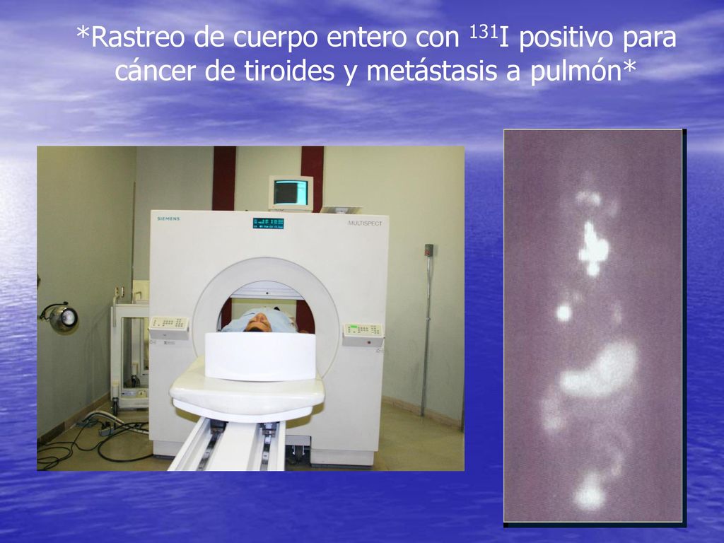*Rastreo de cuerpo entero con 131I positivo para cáncer de tiroides y metástasis a pulmón*