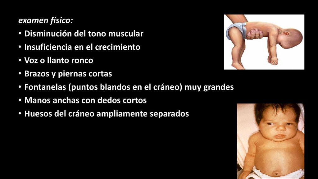 examen físico: Disminución del tono muscular. Insuficiencia en el crecimiento. Voz o llanto ronco.
