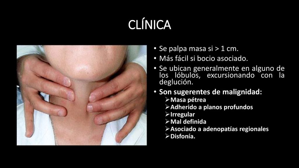 CLÍNICA Se palpa masa si > 1 cm. Más fácil si bocio asociado.