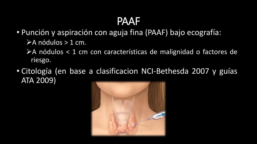 PAAF Punción y aspiración con aguja fina (PAAF) bajo ecografía: