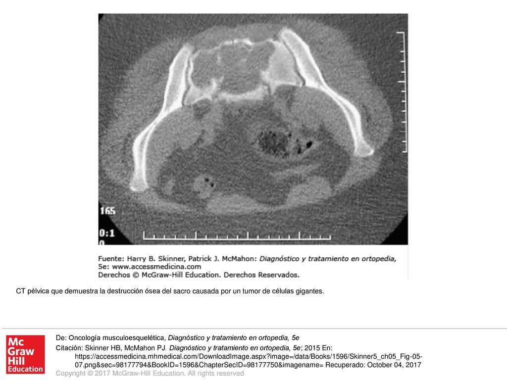 CT pélvica que demuestra la destrucción ósea del sacro causada por un tumor de células gigantes.