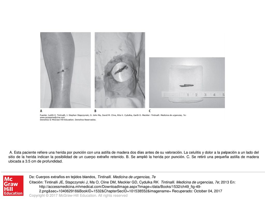 A. Esta paciente refiere una herida por punción con una astilla de madera dos días antes de su valoración. La celulitis y dolor a la palpación a un lado del sitio de la herida indican la posibilidad de un cuerpo extraño retenido. B. Se amplió la herida por punción. C. Se retiró una pequeña astilla de madera ubicada a 3.5 cm de profundidad.