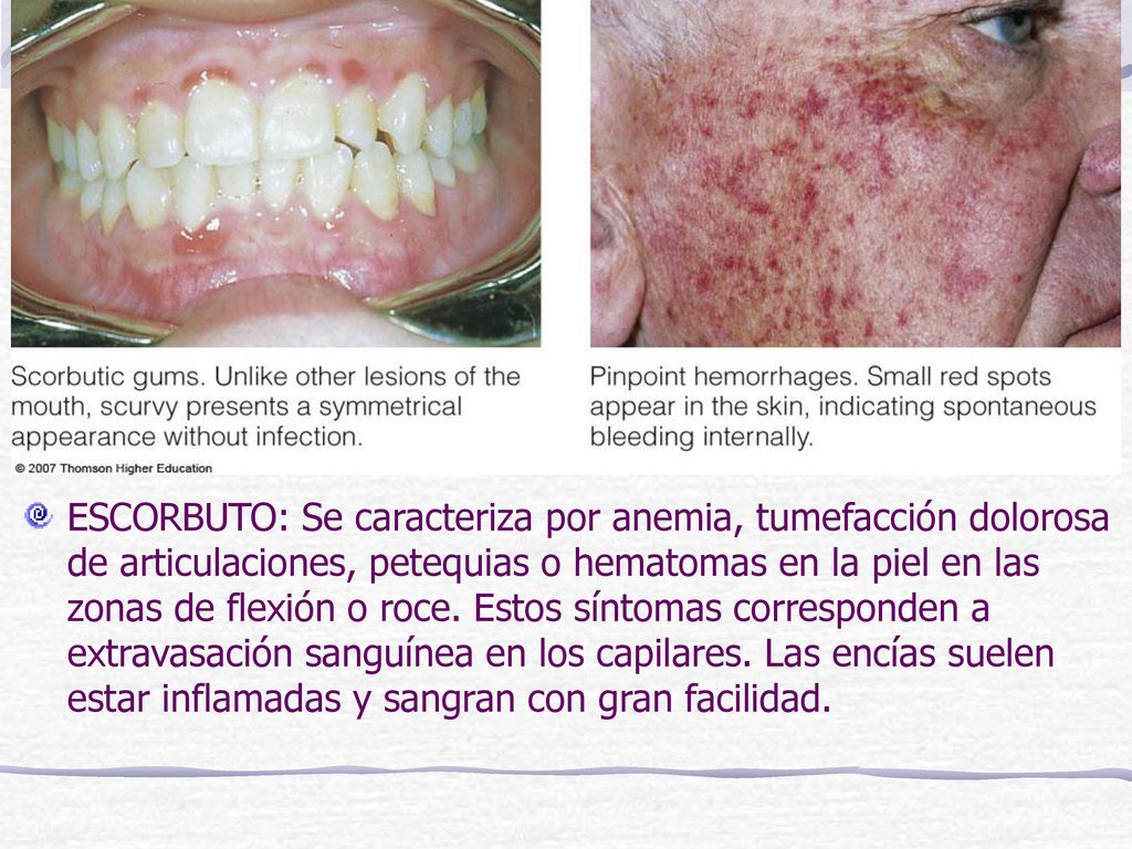 ESCORBUTO: Se caracteriza por anemia, tumefacción dolorosa de articulaciones, petequias o hematomas en la piel en las zonas de flexión o roce.