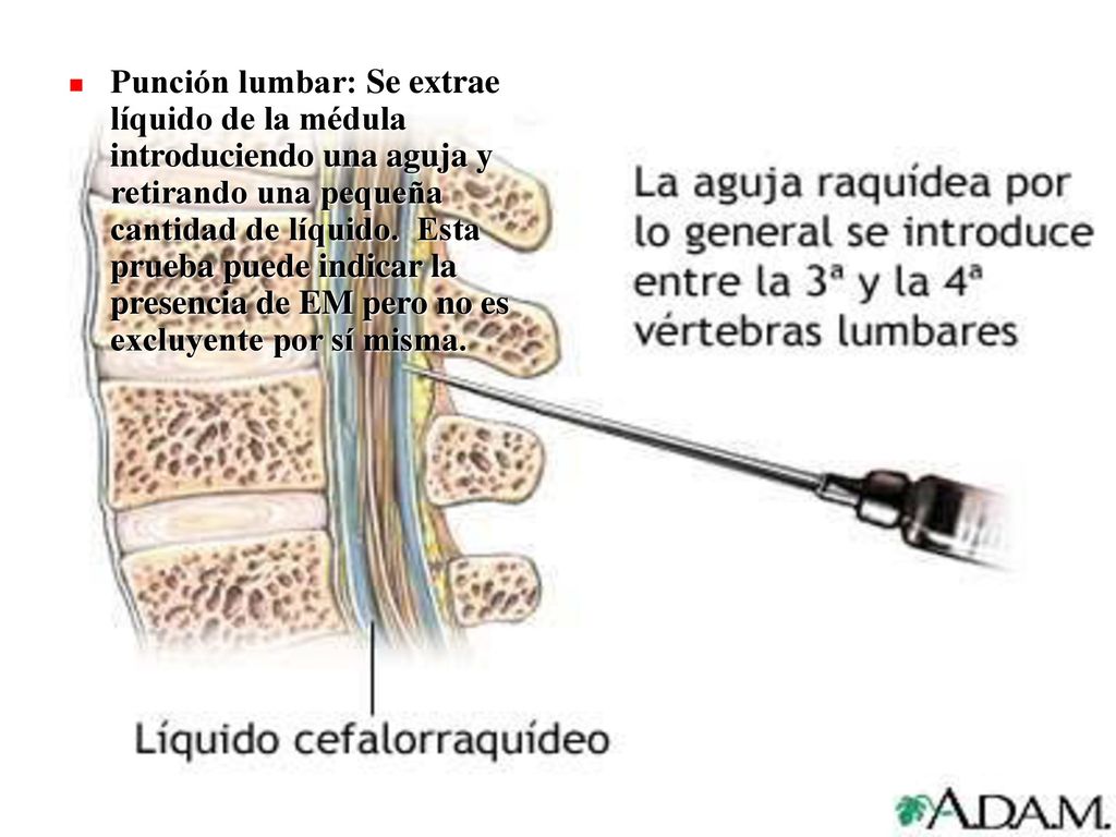 Punción lumbar: Se extrae líquido de la médula introduciendo una aguja y retirando una pequeña cantidad de líquido.