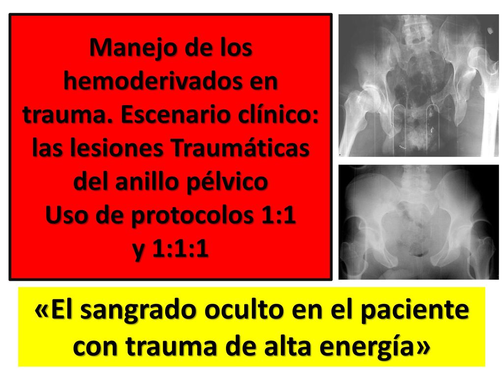 «El sangrado oculto en el paciente con trauma de alta energía»