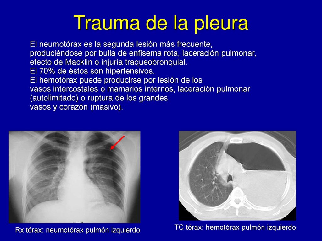 Trauma de la pleura El neumotórax es la segunda lesión más frecuente,