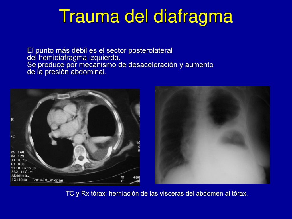 TC y Rx tórax: herniación de las vísceras del abdomen al tórax.