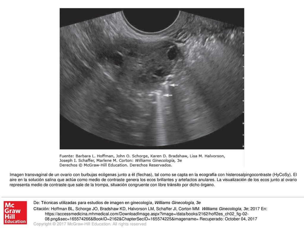 Imagen transvaginal de un ovario con burbujas ecógenas junto a él (flechas), tal como se capta en la ecografía con histerosalpingocontraste (HyCoSy). El aire en la solución salina que actúa como medio de contraste genera los ecos brillantes y artefactos anulares. La visualización de los ecos junto al ovario representa medio de contraste que sale de la trompa, situación congruente con libre tránsito por dicho órgano.