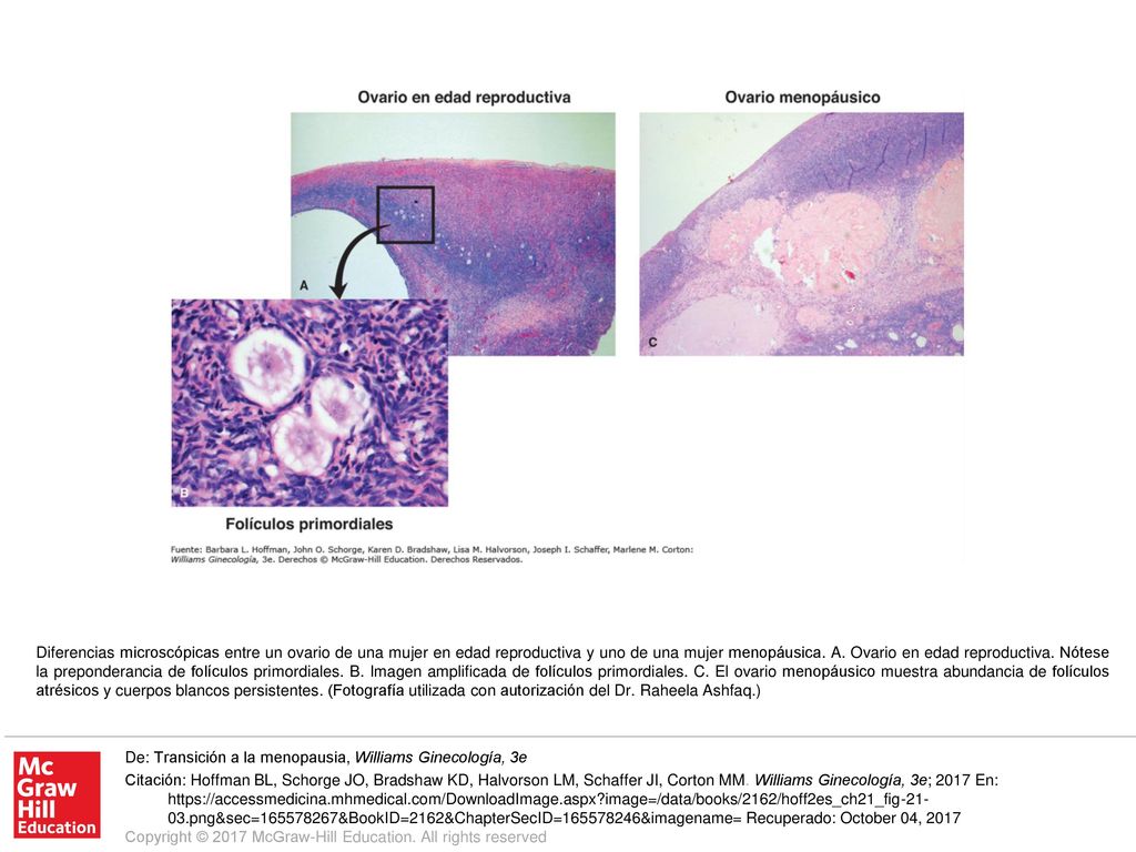 Diferencias microscópicas entre un ovario de una mujer en edad reproductiva y uno de una mujer menopáusica. A. Ovario en edad reproductiva. Nótese la preponderancia de folículos primordiales. B. Imagen amplificada de folículos primordiales. C. El ovario menopáusico muestra abundancia de folículos atrésicos y cuerpos blancos persistentes. (Fotografía utilizada con autorización del Dr. Raheela Ashfaq.)