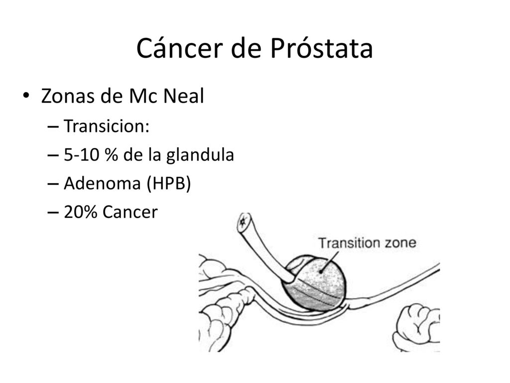 Cáncer de Próstata Zonas de Mc Neal Transicion: 5-10 % de la glandula