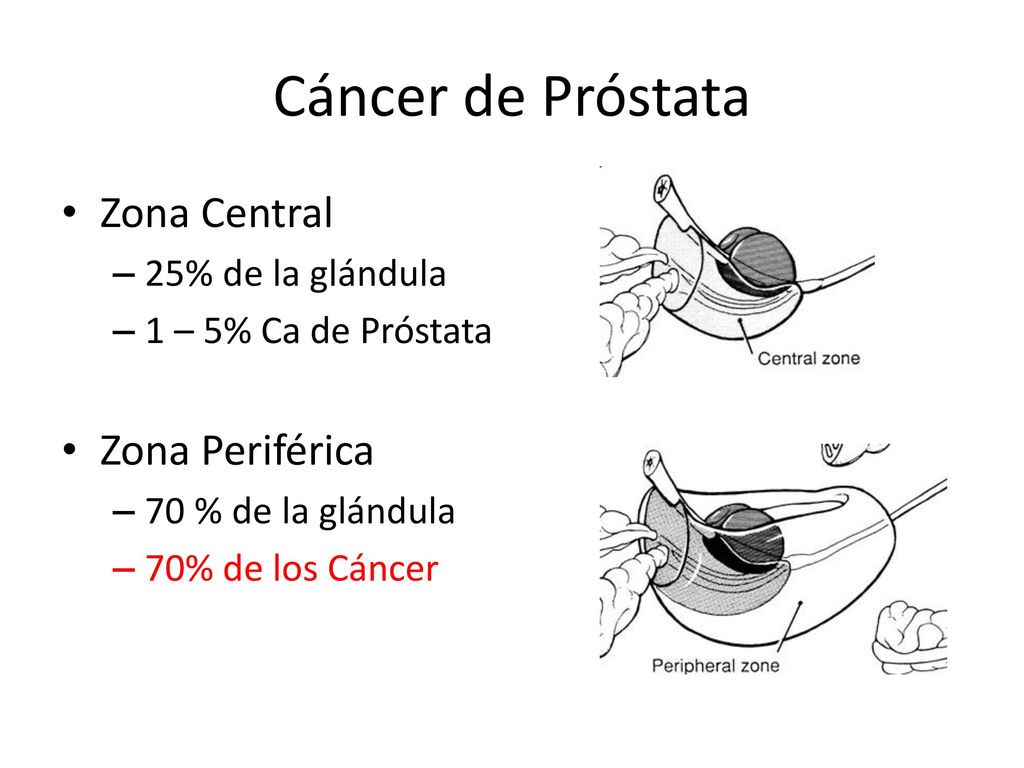 Cáncer de Próstata Zona Central Zona Periférica 25% de la glándula