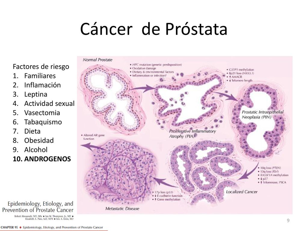 Cáncer de Próstata Factores de riesgo Familiares Inflamación Leptina