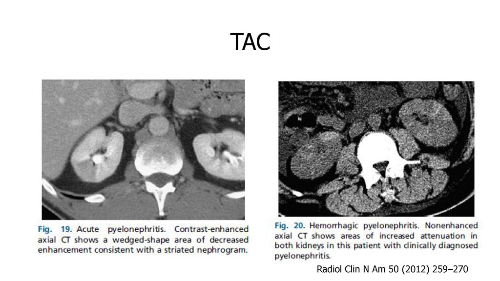 TAC FIG 19: TAC CONTRASTADO: MUESTRA IMAGEN EN FORMA DE CUÑA CON DISMINUCIÓN DEL REALCE (NEFROGRAMA ESTRIADO)