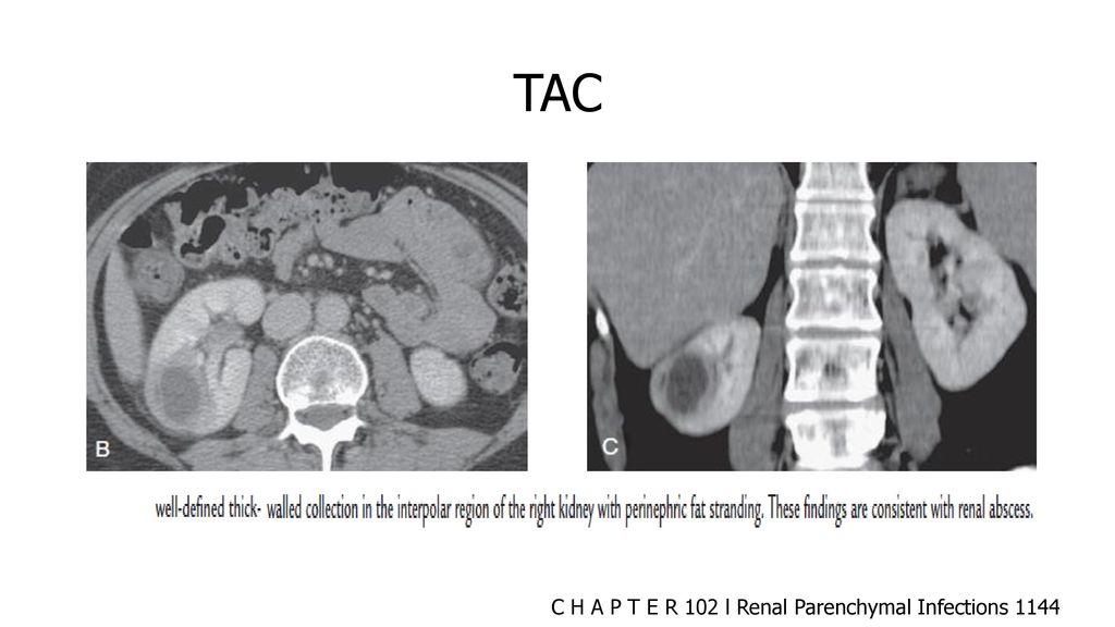 TAC C H A P T E R 102 l Renal Parenchymal Infections 1144