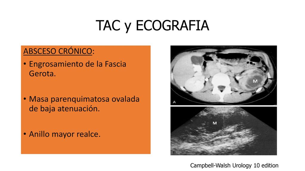 TAC y ECOGRAFIA ABSCESO CRÓNICO: Engrosamiento de la Fascia Gerota.