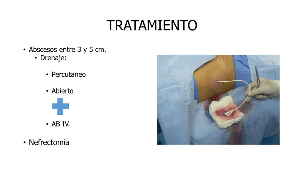 TRATAMIENTO Nefrectomía Abscesos entre 3 y 5 cm. Drenaje: Percutaneo