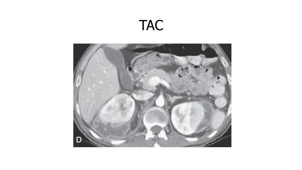 TAC ---Capaz de mostrar con exquisito detalle anatómico la ruta de propagación de la infección en los tejidos circundantes (Fig ).