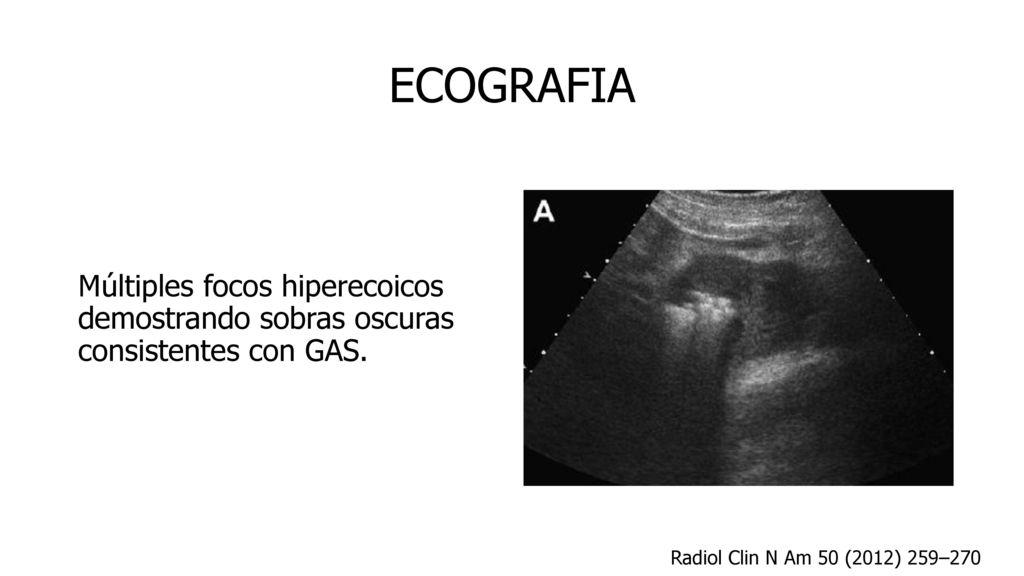 ECOGRAFIA Múltiples focos hiperecoicos demostrando sobras oscuras consistentes con GAS.