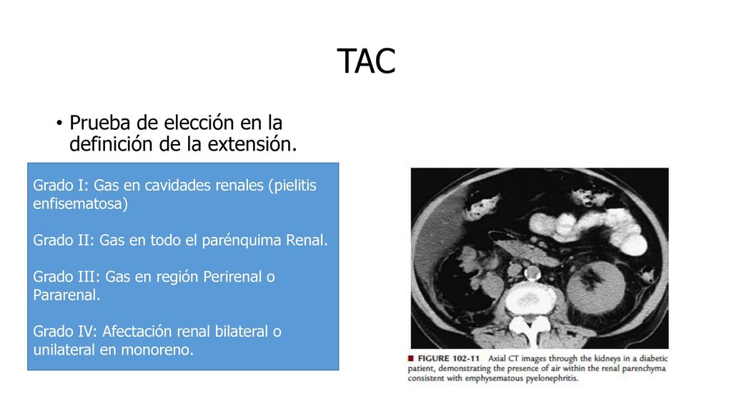 TAC Prueba de elección en la definición de la extensión.