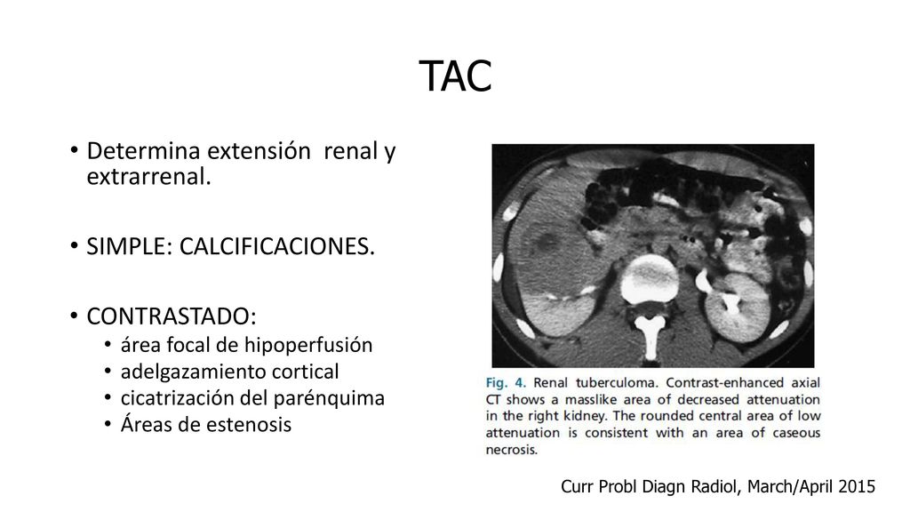 TAC Determina extensión renal y extrarrenal. SIMPLE: CALCIFICACIONES.