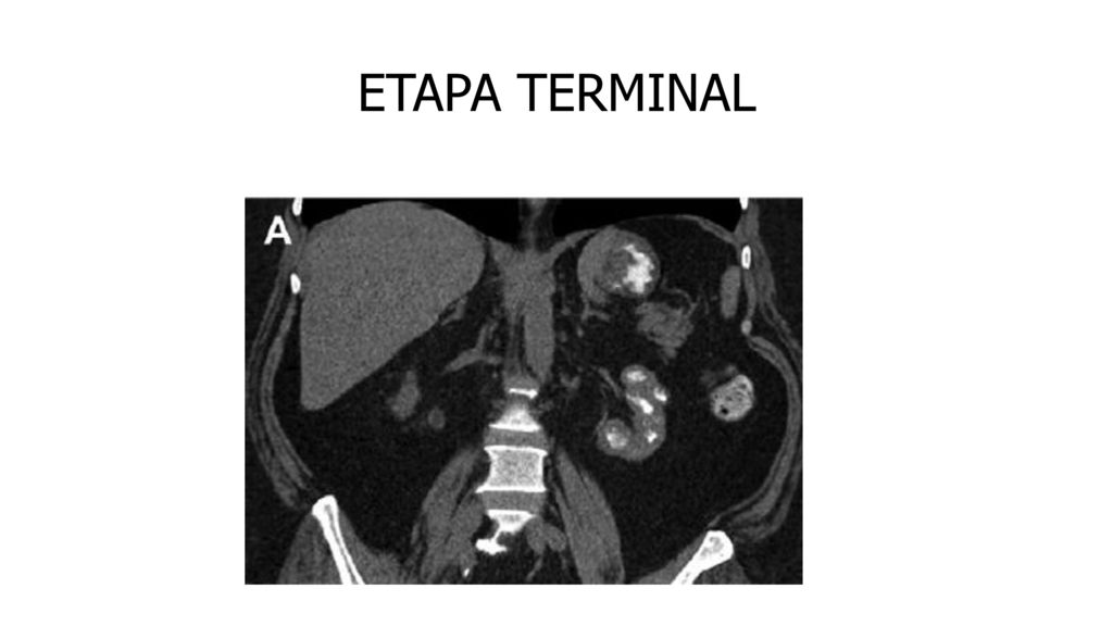 ETAPA TERMINAL End-stage renal tuberculosis. (A) Nonenhanced coronal CT shows calcifications replacing most of the atrophic.