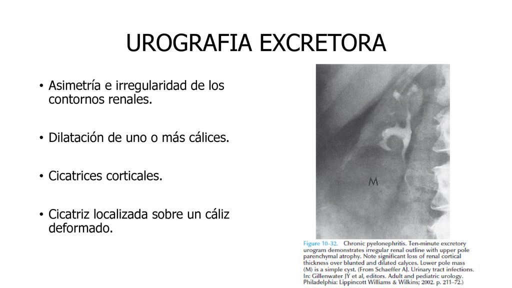 UROGRAFIA EXCRETORA Asimetría e irregularidad de los contornos renales. Dilatación de uno o más cálices.