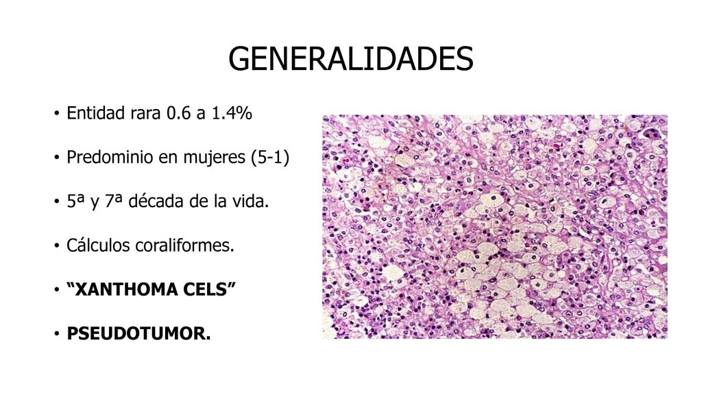 GENERALIDADES Entidad rara 0.6 a 1.4% Predominio en mujeres (5-1)