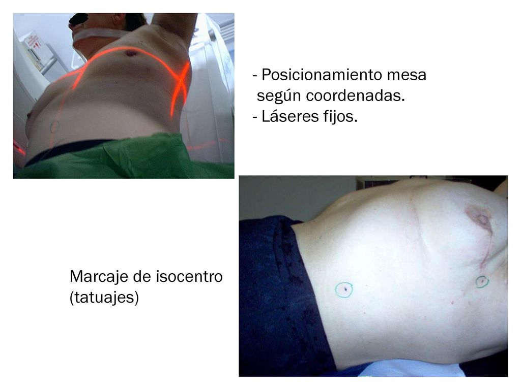 Posicionamiento mesa según coordenadas. Láseres fijos. Marcaje de isocentro (tatuajes)