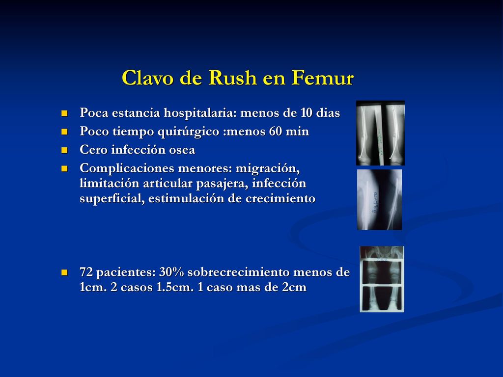 Clavo de Rush en Femur Poca estancia hospitalaria: menos de 10 dias